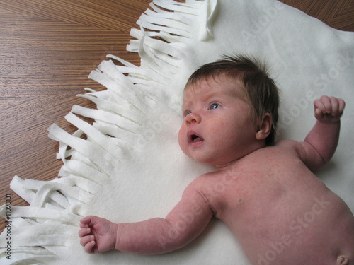 Photo: young baby with a rash young baby with a rash
