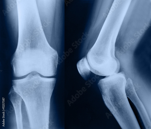 X-ray picture showing knee joints with arthrosis