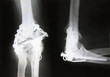 X-ray of fractured elbow with different metal fixators