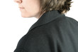 Shoulder with dandruff