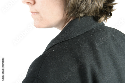 Photo: Shoulder with dandruff Shoulder with dandruff