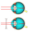 Shortsighted eye corrected with a concave lens