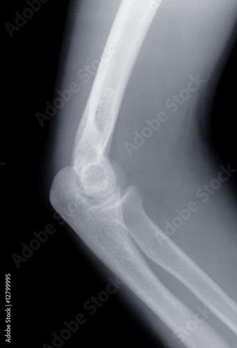 Photo: X-ray of a human knee X-ray of a human knee