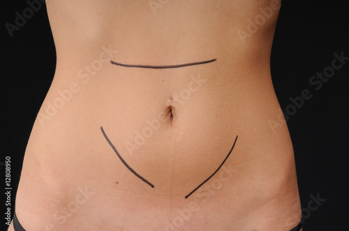 Photo: female belly prepared for a fat removal female belly prepared for a fat removal
