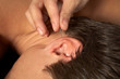Acupuncture of ear