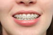 Girl smiles with braces
