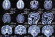 X-ray picture of a brain