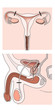 Sterilisation