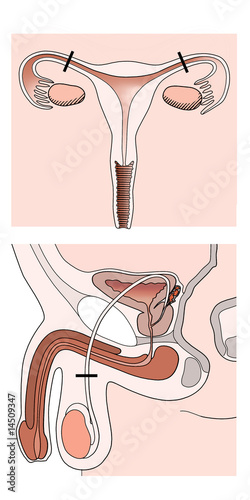 Illustration: Sterilisation Sterilisation