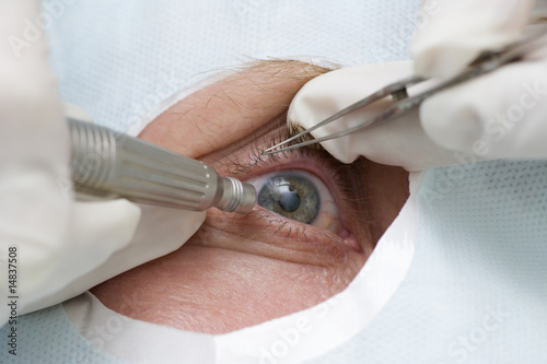Photo: Treatment of an eye by ultrasound Treatment of an eye by ultrasound