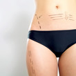 Plastic surgery patient's abdomen and thigh Plastic surgery patient's abdomen and thigh