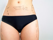 Marked body for cosmetic surgery Marked body for cosmetic surgery