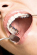 mouth care