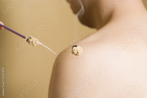 Photo: 男性の肩に灸頭鍼 男性の肩に灸頭鍼