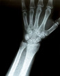 Xray of a wrist Xray of a wrist