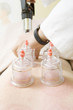Chinese traditional cupping therapy for improved circulation