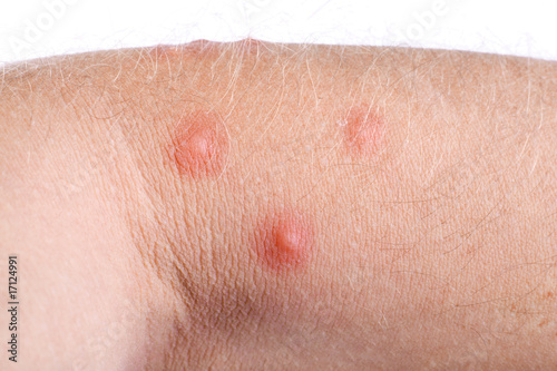 Photo: pimples on skin pimples on skin