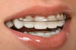 Dental Braces