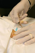 Lap-Band Procedure for the obese