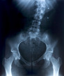 Female Pelvis X-Ray. Details: curved spine, surgical pins. Female Pelvis X-Ray. Details: curved spine, surgical pins.
