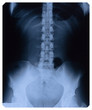 X-RAY film of female lower thorax and pelvis X-RAY film of female lower thorax and pelvis