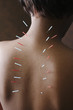 Acupuncture needles in African woman's back