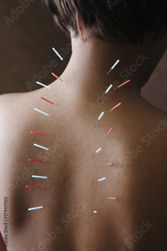 Photo: Acupuncture needles in African woman's back Acupuncture needles in African woman's back