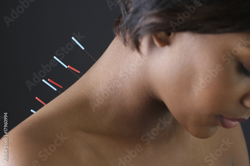 Photo: Acupuncture needles in African woman's back Acupuncture needles in African woman's back