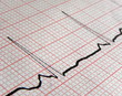 électrocardiogramme