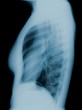 Radiographie pulmonaire de profil
