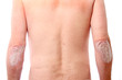 Schuppenpflechte-Psoriasis an beiden Ellenbogen