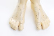 acupuncture