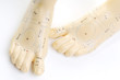 acupuncture