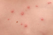 Chickenpox