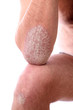 schuppenflechte - psoriasis am Armen und beinen