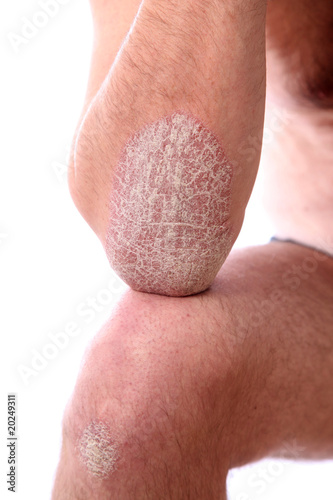 Foto: schuppenflechte - psoriasis am Armen und beinen schuppenflechte - psoriasis am Armen und beinen