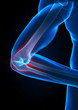 X-ray elbow pain concept X-ray elbow pain concept