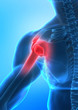 Arm pain concept