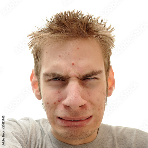 Photo: Teenager Acne Problem Teenager Acne Problem