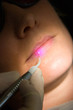 Foto: Laser Dental Zahnbehandlung Herpes Aphten Lippen Laser Dental Zahnbehandlung Herpes Aphten Lippen