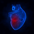 Heart attack