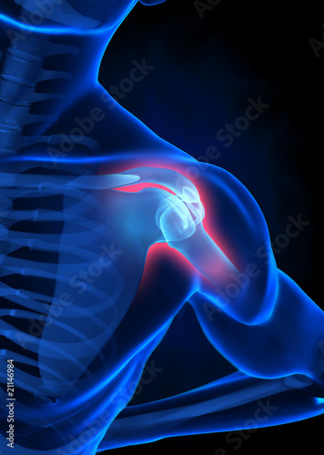 Illustration: injured arm concept injured arm concept