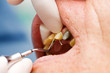 Dental cord placing in gingival sulcus