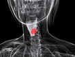 weiblicher Kehlkopf mit Tumor