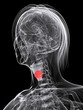 weiblicher Kehlkopf mit Tumor