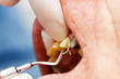 Dental cord placing in gingival sulcus Dental cord placing in gingival sulcus