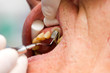 Dental cord placing in gingival sulcus Dental cord placing in gingival sulcus