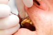 Dental cord placing in gingival sulcus Dental cord placing in gingival sulcus