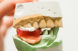 Bite registration - right side