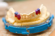 Remodeling of teeth of wax